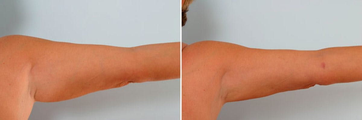 Female Liposuction Before & After Gallery - Patient 54876213 - Image 5