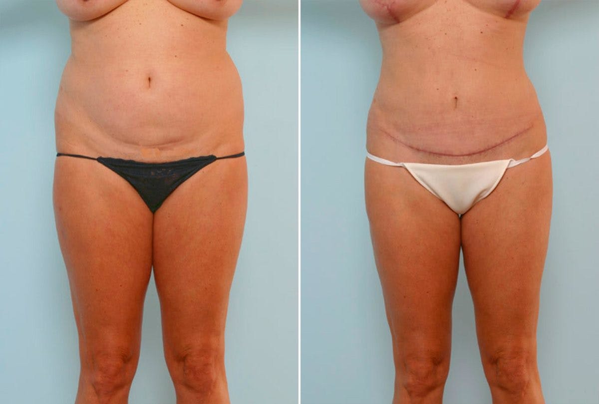 Abdominoplasty Before & After Gallery - Patient 54876230 - Image 1