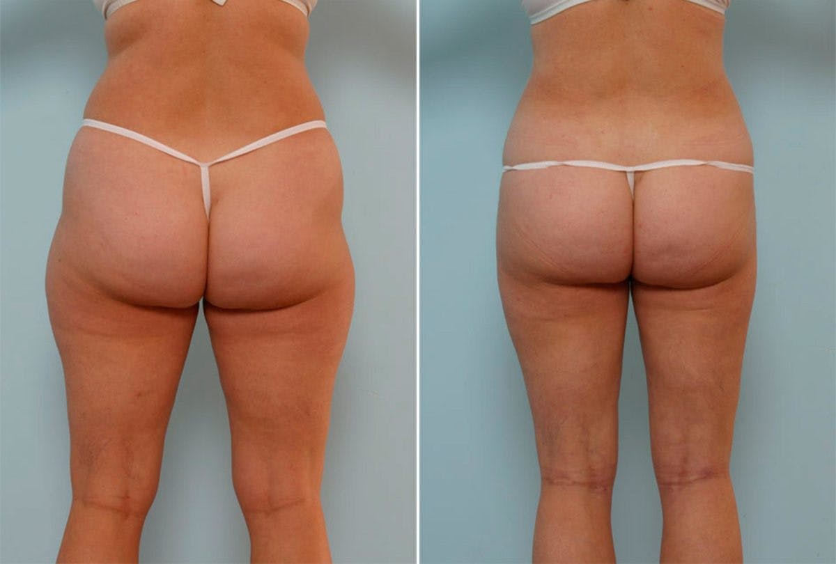 Female Liposuction Before & After Gallery - Patient 54876229 - Image 3