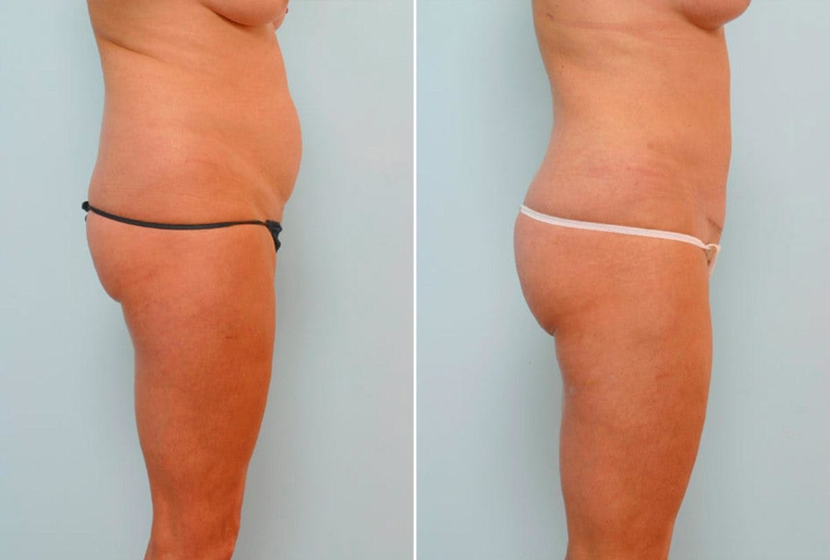 Abdominoplasty Before & After Gallery - Patient 54876230 - Image 3