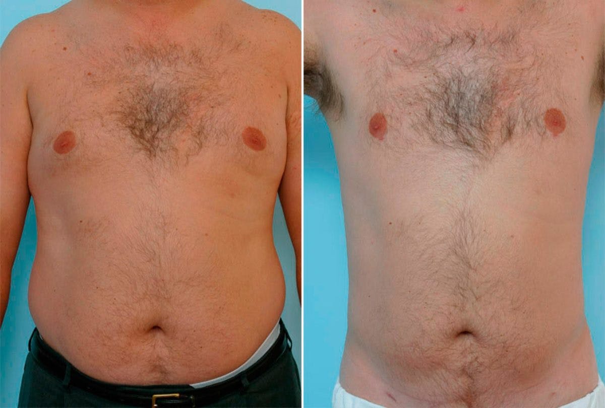 Male Liposuction Before & After Gallery - Patient 55485574 - Image 1