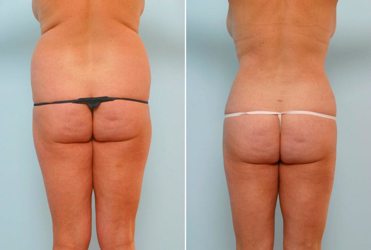 Abdominoplasty Before & After Gallery - Patient 54876230 - Image 4