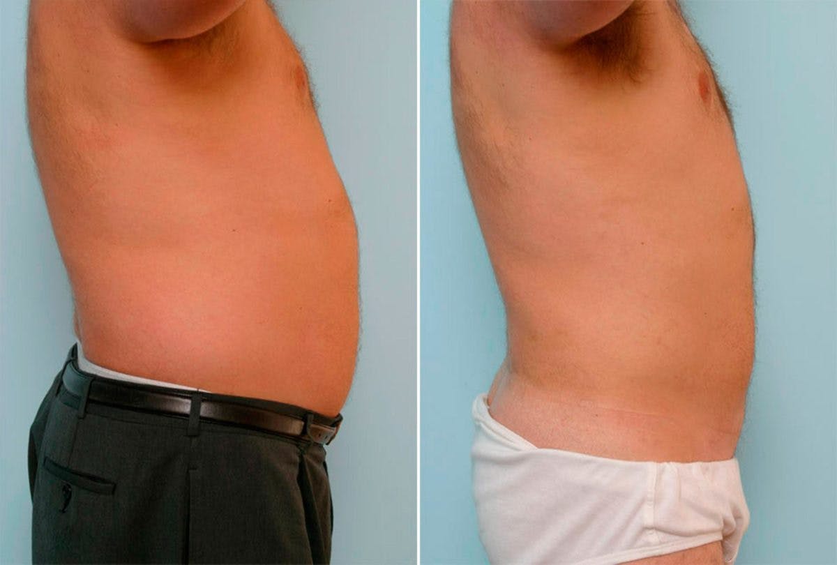 Male Liposuction Before & After Gallery - Patient 55485574 - Image 2