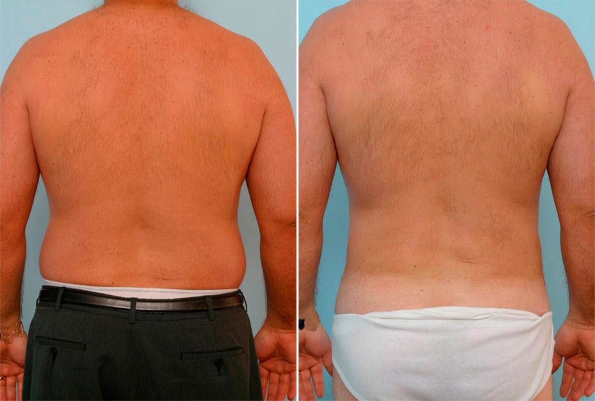 Male Liposuction Before & After Photo - Patient 55485574 - Image 3