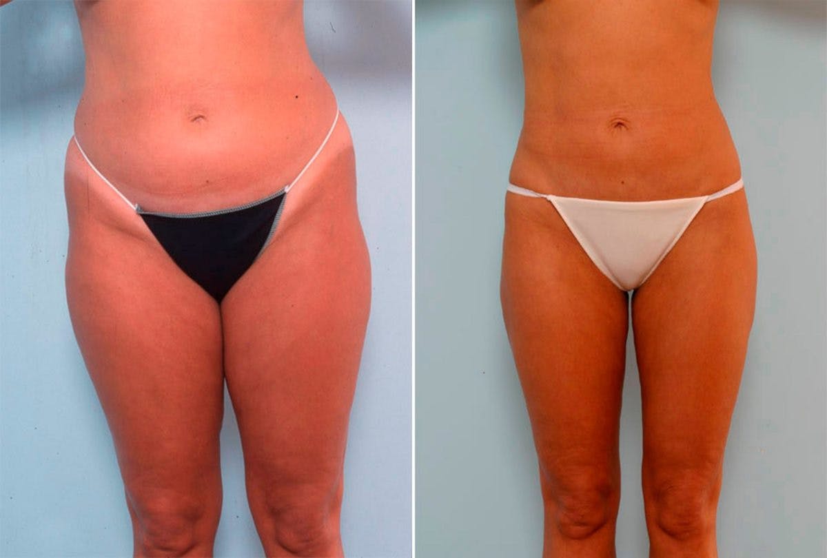 Female Liposuction Before & After Gallery - Patient 54876259 - Image 1