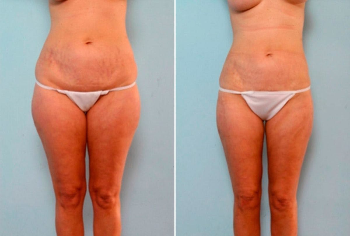 Female Liposuction Before & After Photo - Patient 54876275 - Image 1