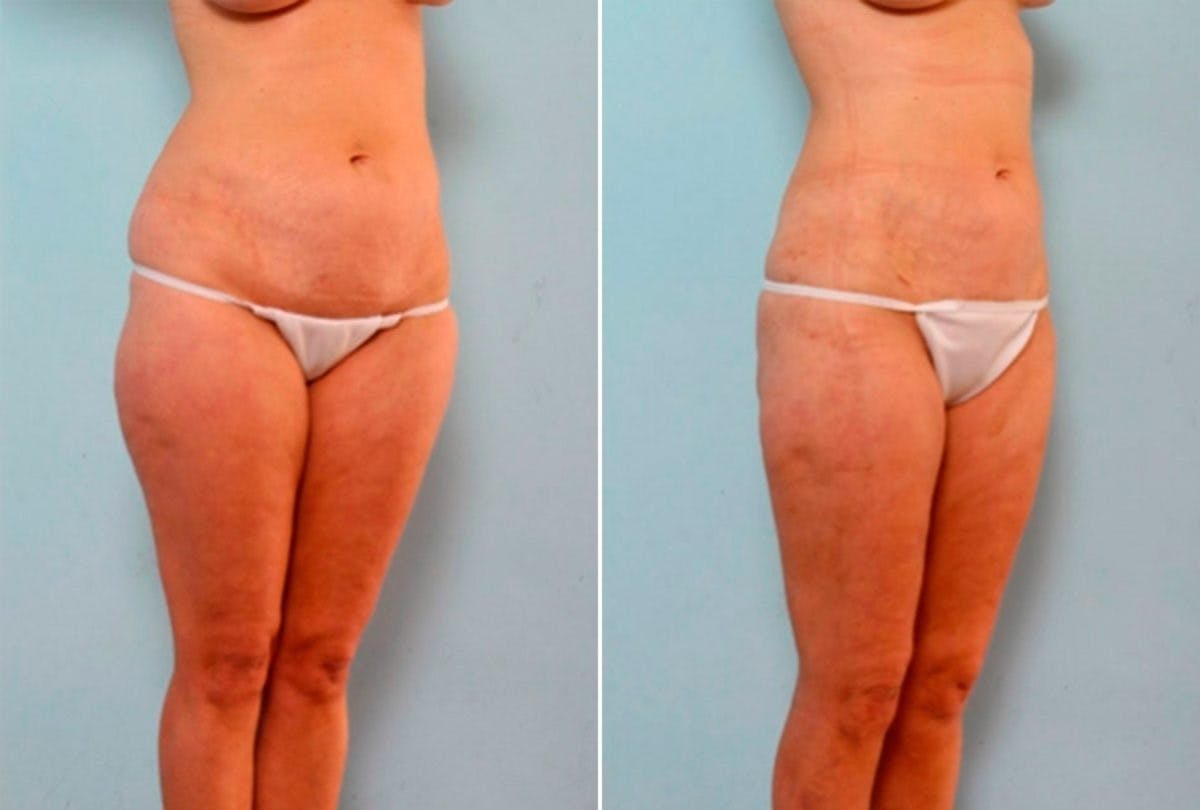 Female Liposuction Before & After Photo - Patient 54876275 - Image 2