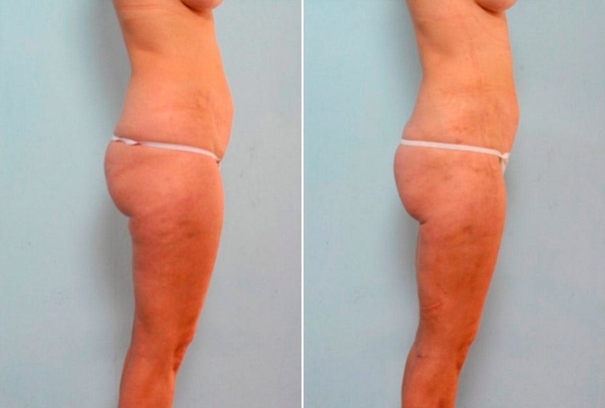 Female Liposuction Before & After Gallery - Patient 54876275 - Image 3