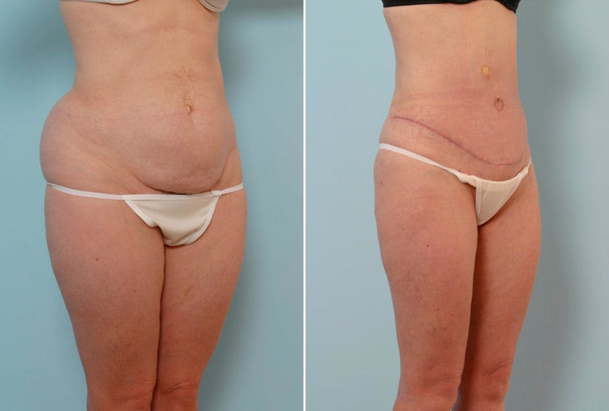 Abdominoplasty Before & After Gallery - Patient 54876279 - Image 2