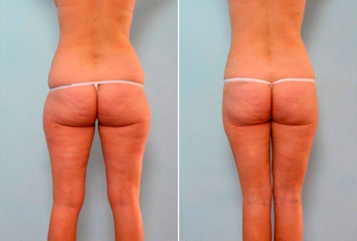 Female Liposuction Before & After Gallery - Patient 54876275 - Image 4