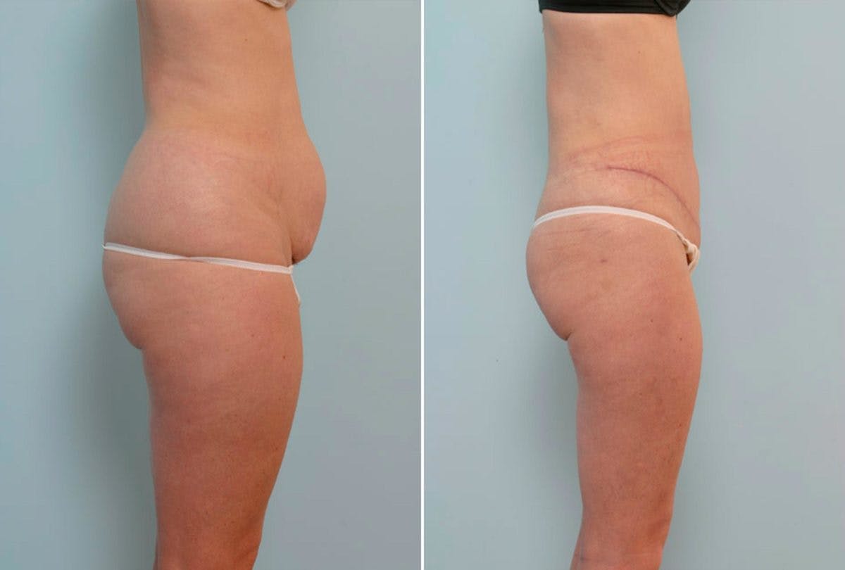 Abdominoplasty Before & After Gallery - Patient 54876279 - Image 3