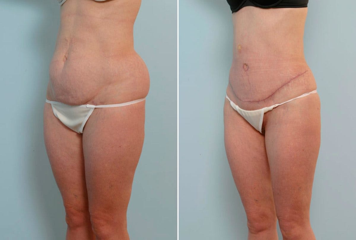 Abdominoplasty Before & After Photo - Patient 54876279 - Image 4