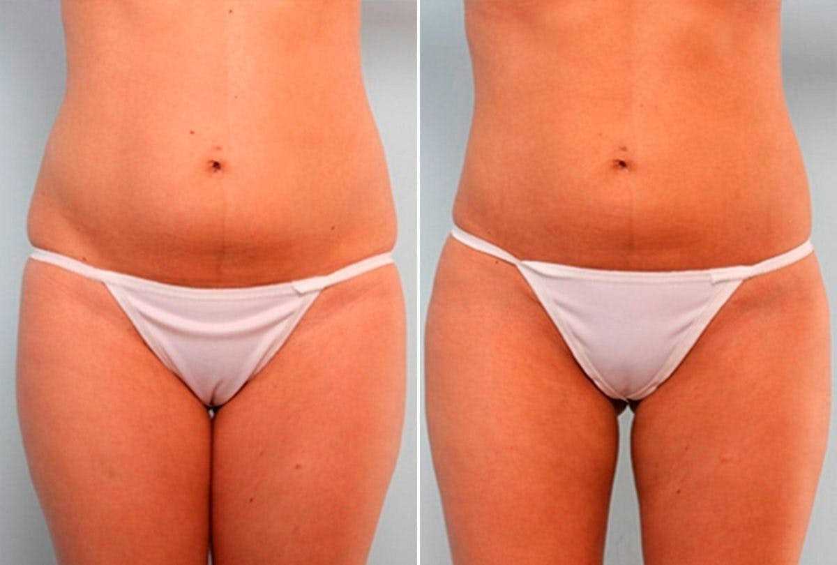 Female Liposuction Before & After Gallery - Patient 54876280 - Image 1