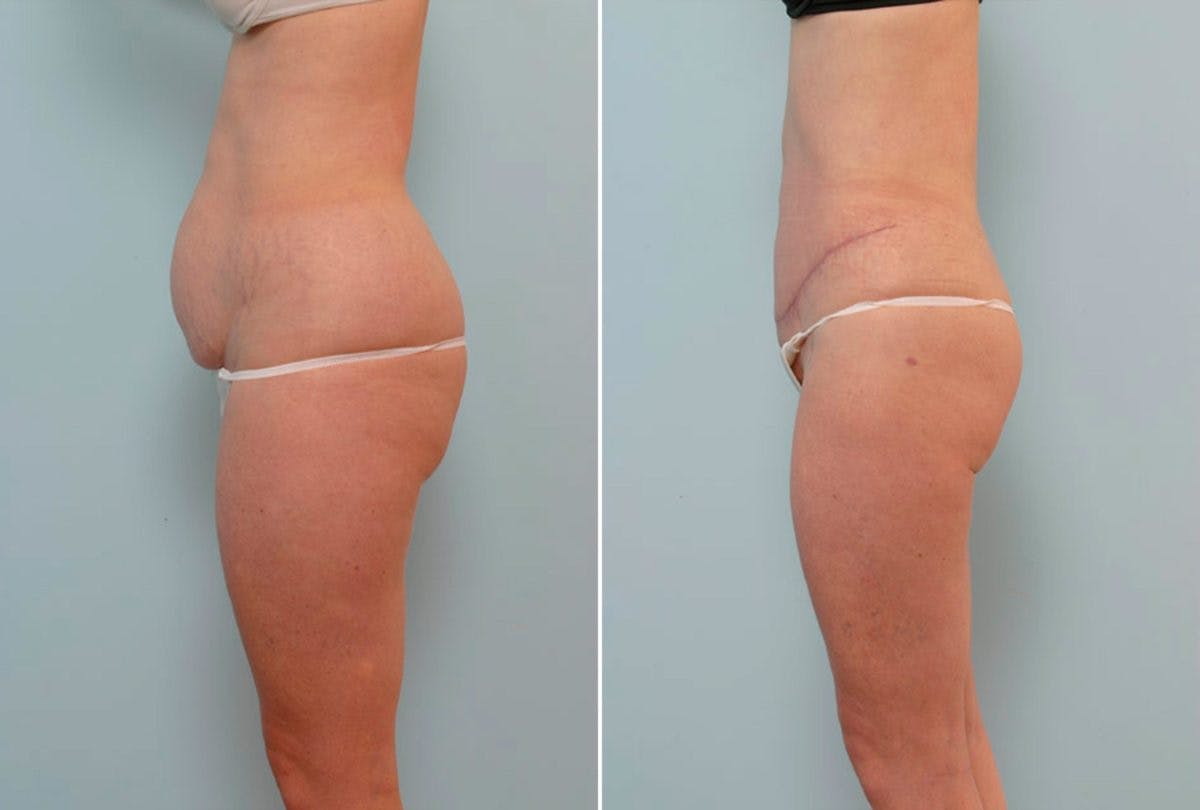 Abdominoplasty Before & After Gallery - Patient 54876279 - Image 5