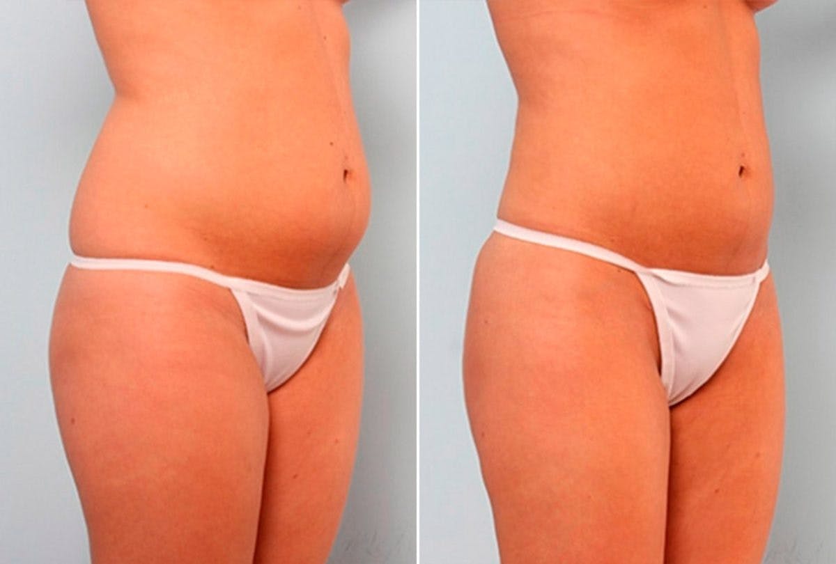 Female Liposuction Before & After Gallery - Patient 54876280 - Image 2