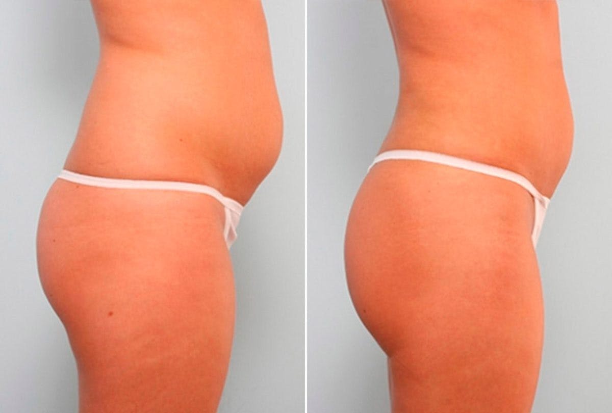 Female Liposuction Before & After Gallery - Patient 54876280 - Image 3