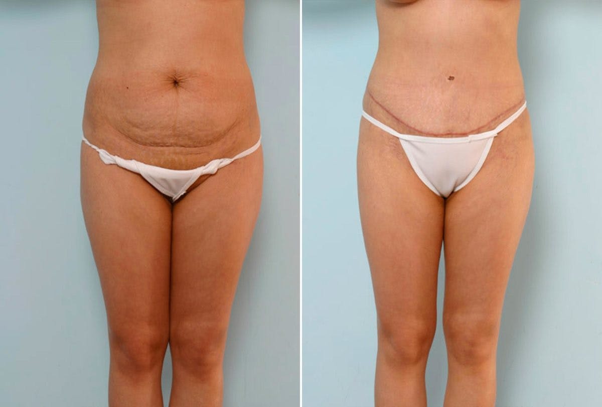 Abdominoplasty Before & After Gallery - Patient 54876294 - Image 1