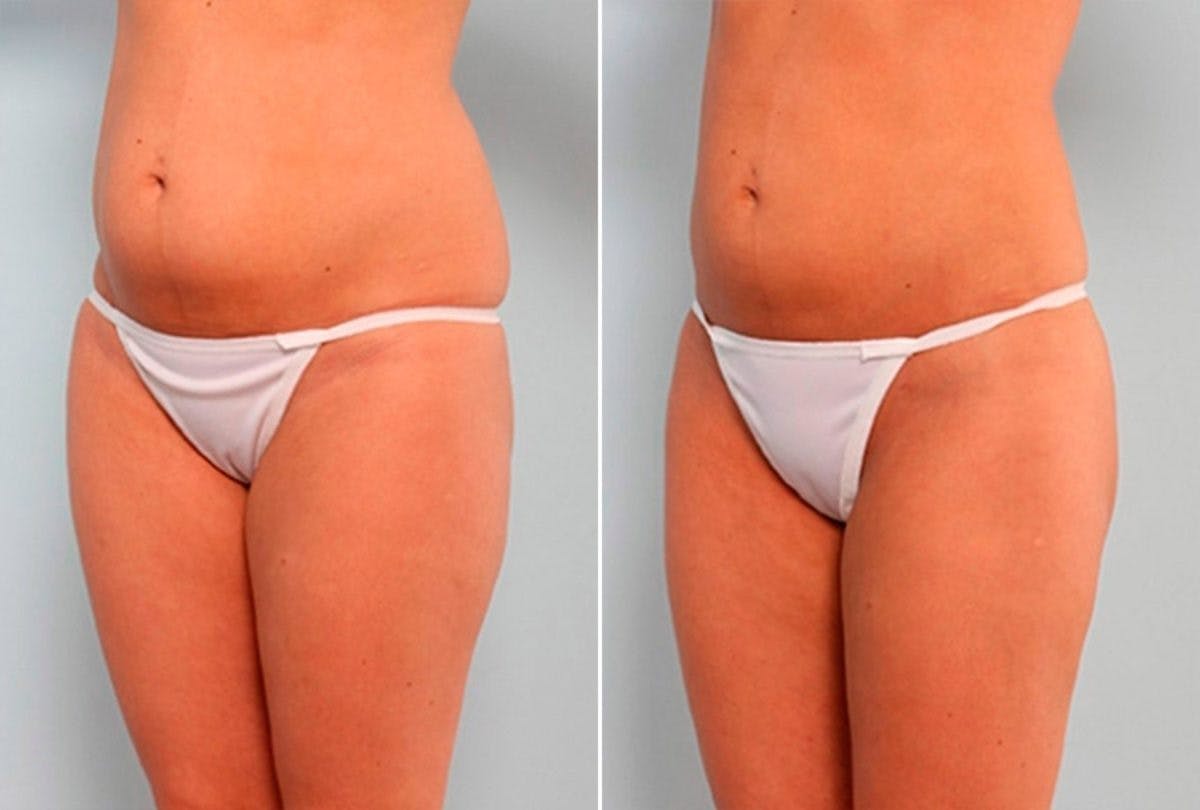 Female Liposuction Before & After Gallery - Patient 54876280 - Image 4