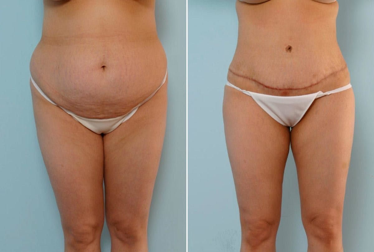 Abdominoplasty Before & After Gallery - Patient 54876297 - Image 1