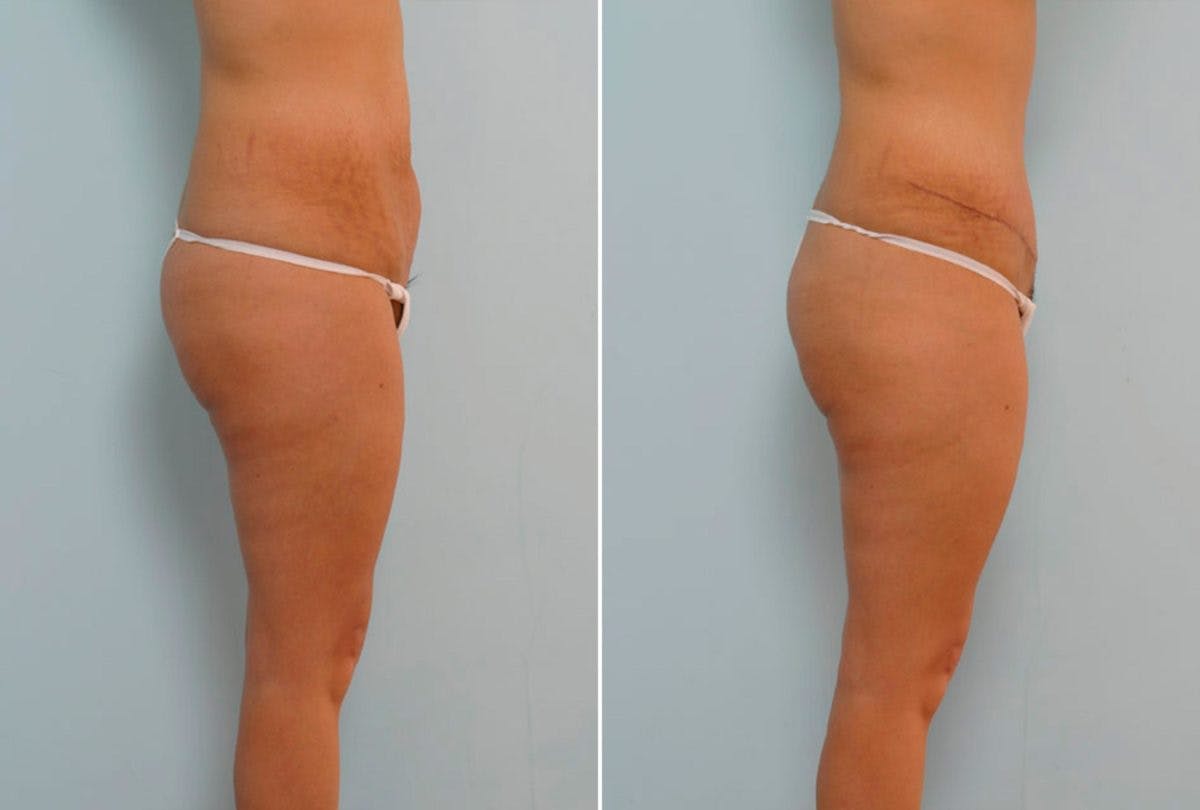 Abdominoplasty Before & After Gallery - Patient 54876299 - Image 3
