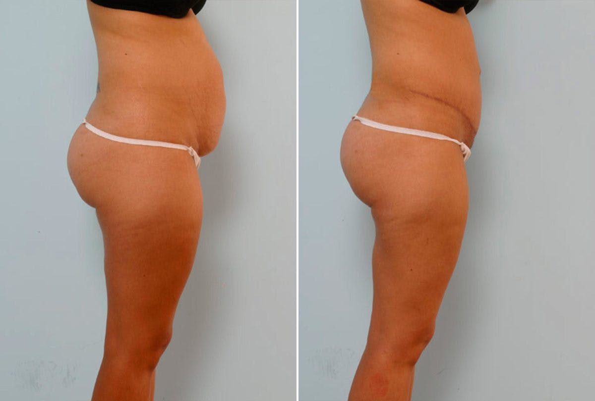 Abdominoplasty Before & After Gallery - Patient 54876326 - Image 3