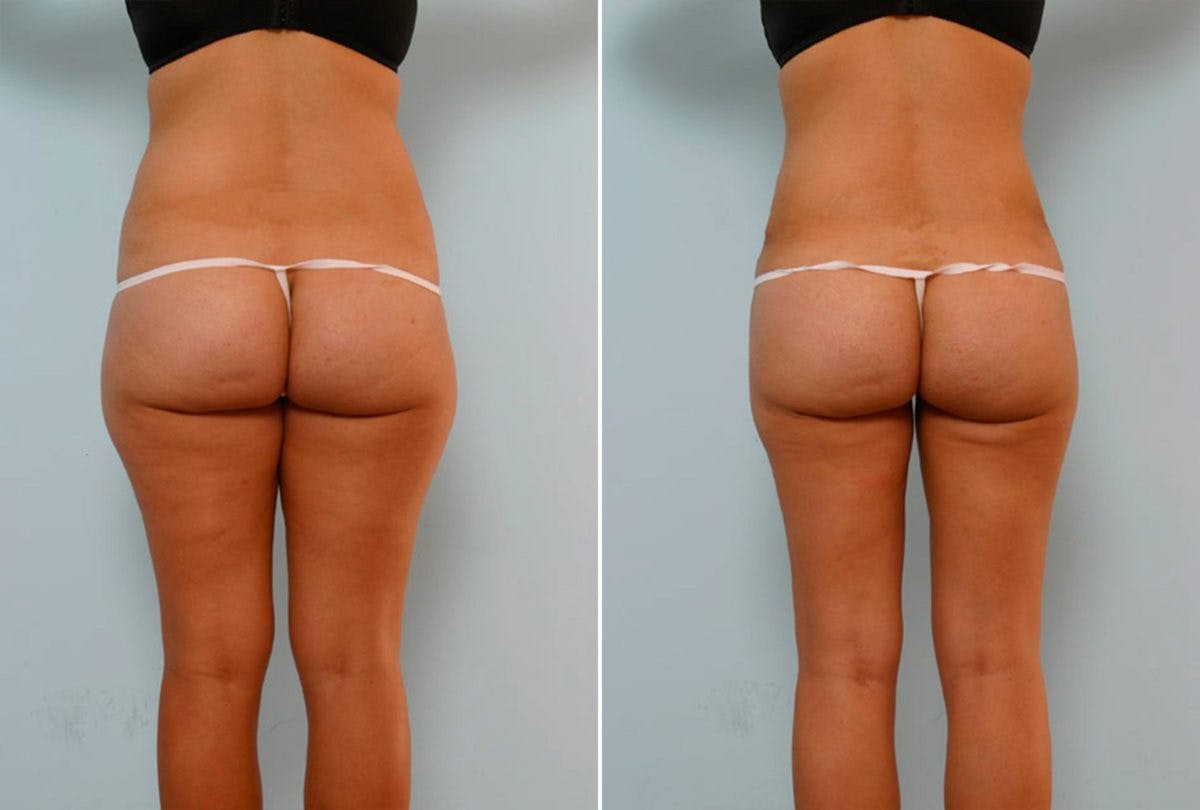 Abdominoplasty Before & After Gallery - Patient 54876326 - Image 4