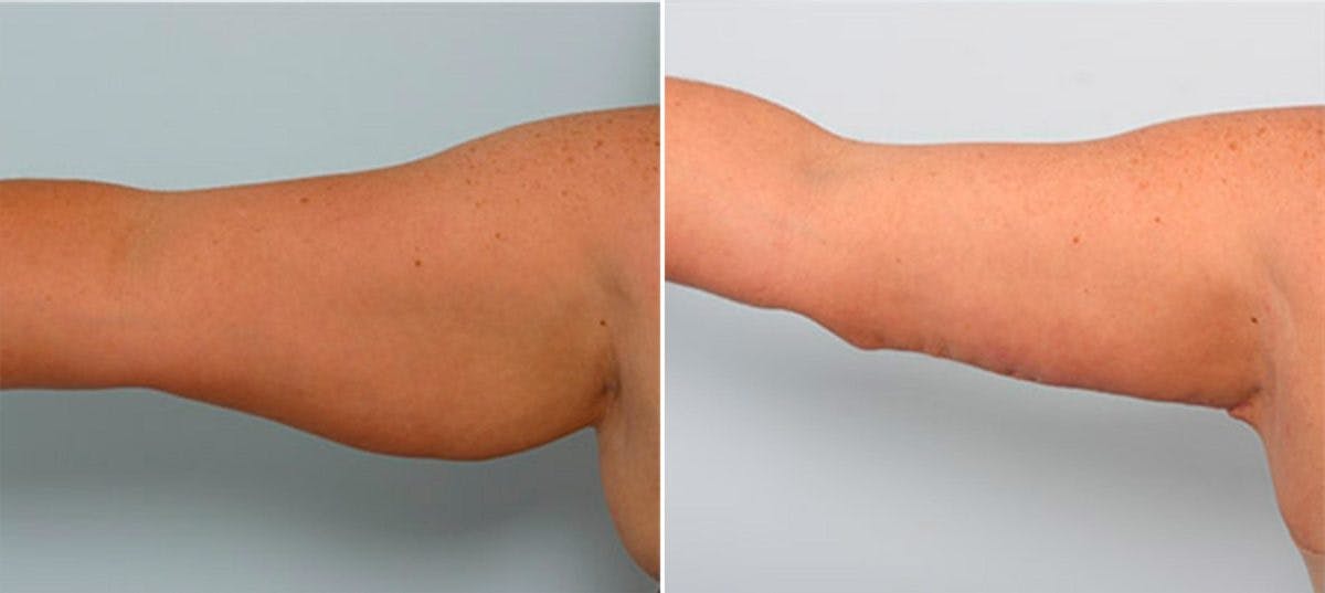 Brachioplasty (Arm Lift) Before & After Photo - Patient 54880559 - Image 2
