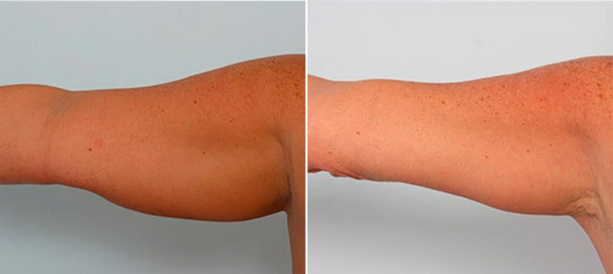 Brachioplasty (Arm Lift) Before & After Photo - Patient 54880560 - Image 2