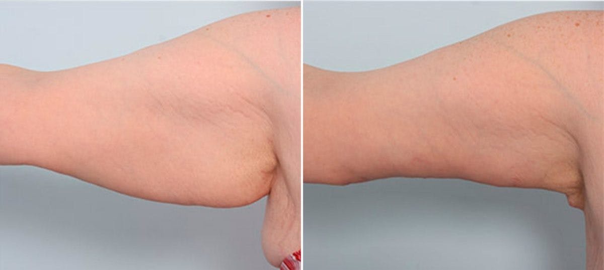 Brachioplasty (Arm Lift) Before & After Gallery - Patient 54880562 - Image 2
