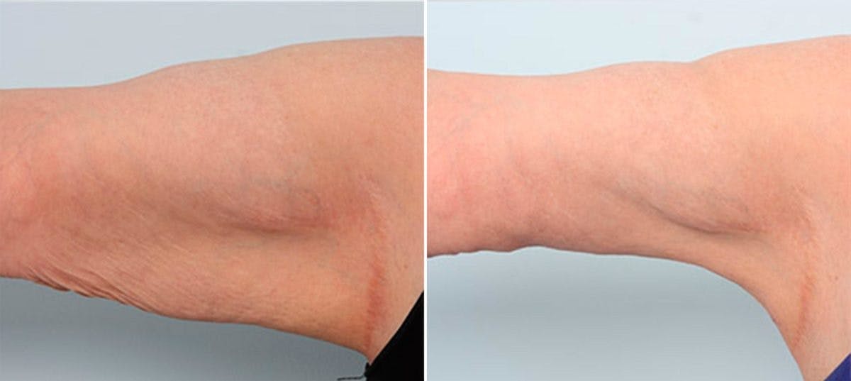 Brachioplasty (Arm Lift) Before & After Gallery - Patient 54880565 - Image 2