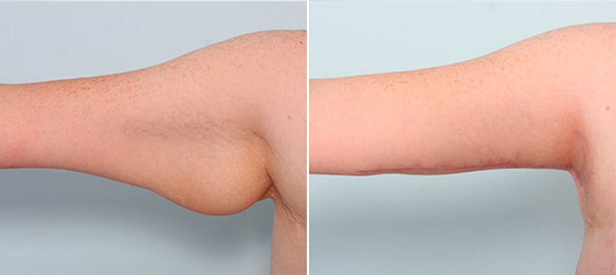 Brachioplasty (Arm Lift) Before & After Photo - Patient 54880567 - Image 2