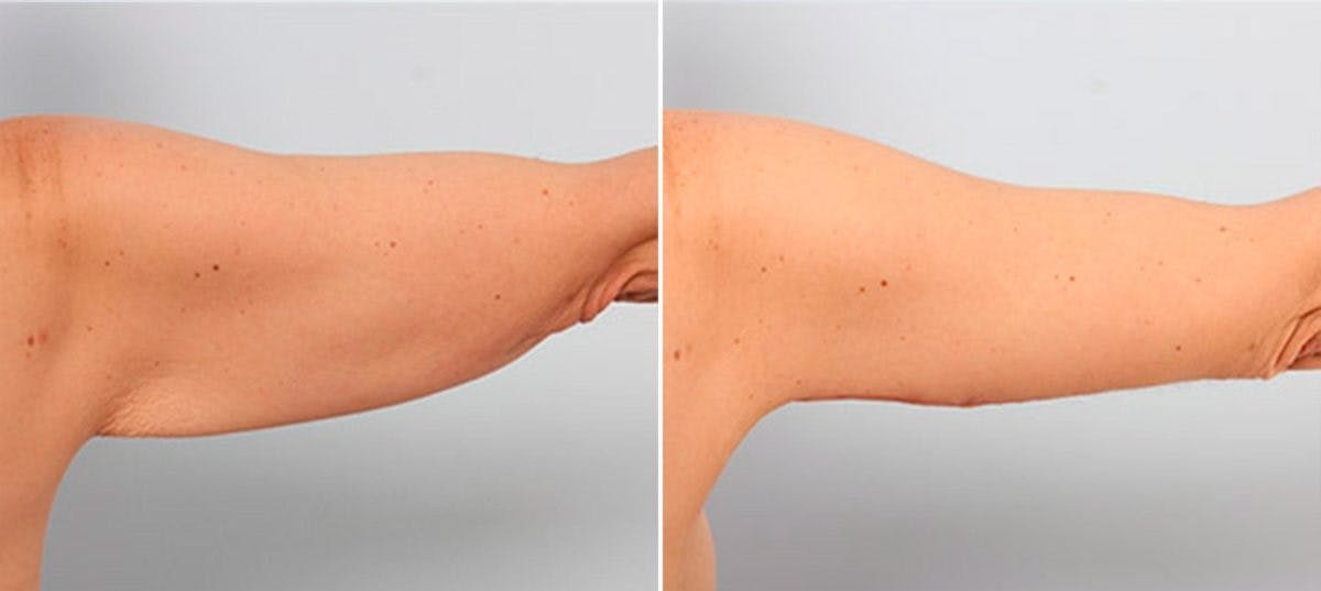 Brachioplasty (Arm Lift) Before & After Gallery - Patient 54880571 - Image 1