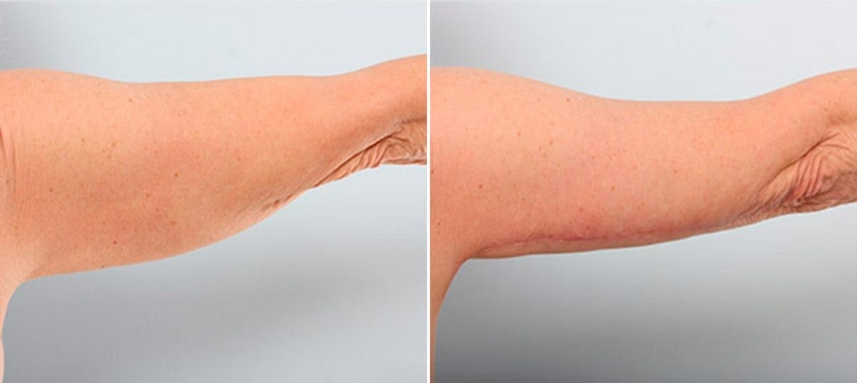 Brachioplasty (Arm Lift) Before & After Gallery - Patient 54880575 - Image 1