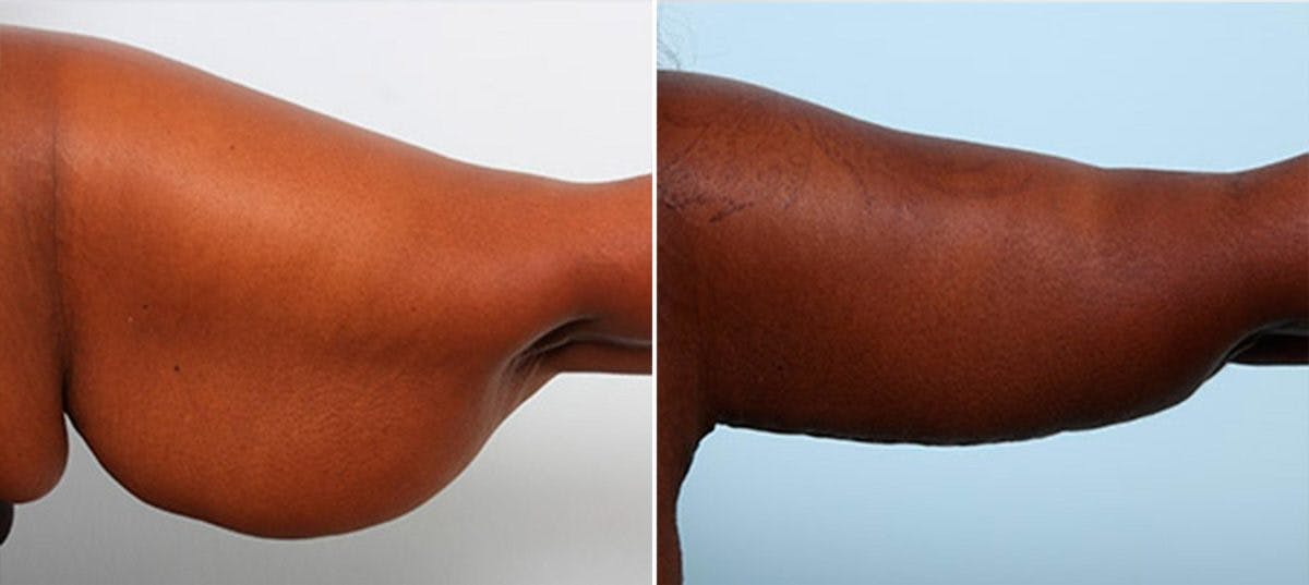 Brachioplasty (Arm Lift) Before & After Gallery - Patient 54880576 - Image 1