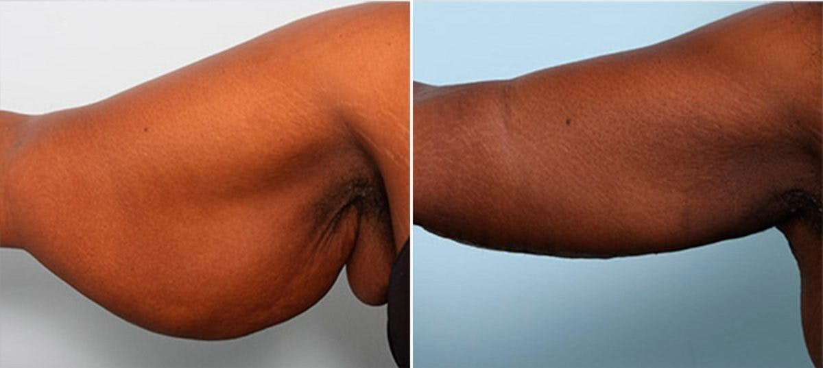 Brachioplasty (Arm Lift) Before & After Gallery - Patient 54880576 - Image 2