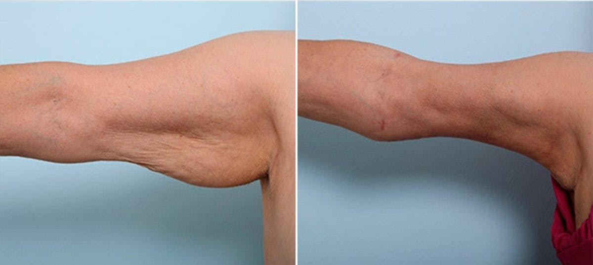 Brachioplasty (Arm Lift) Before & After Photo - Patient 54880596 - Image 2