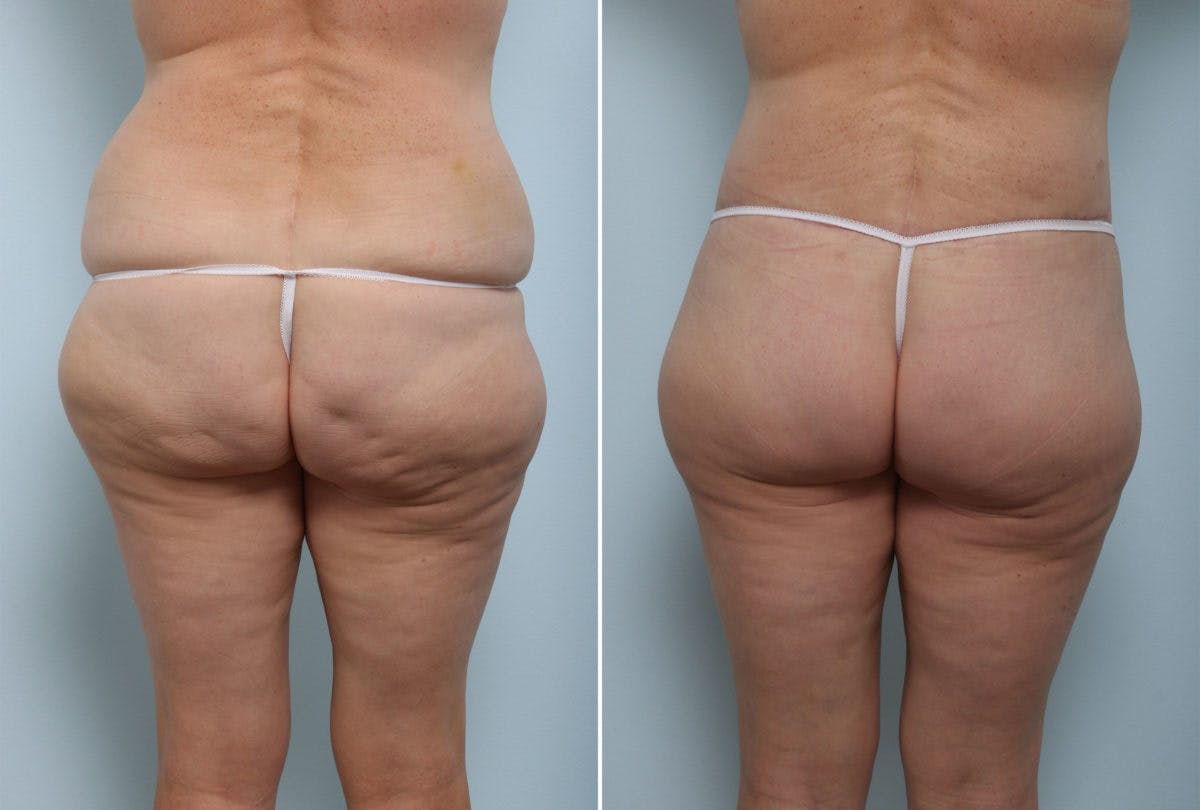 Back Lift Before & After Gallery - Patient 54881697 - Image 1