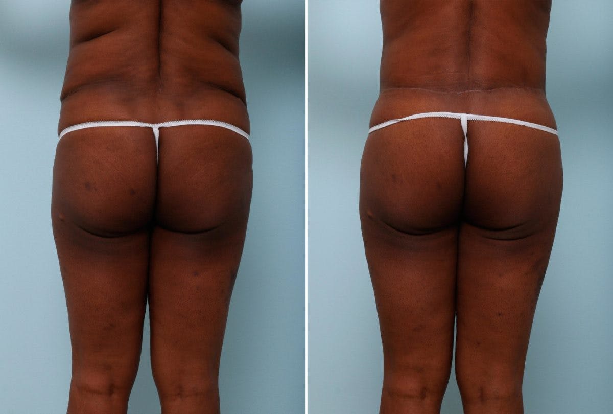 Back Lift Before & After Gallery - Patient 54881698 - Image 1