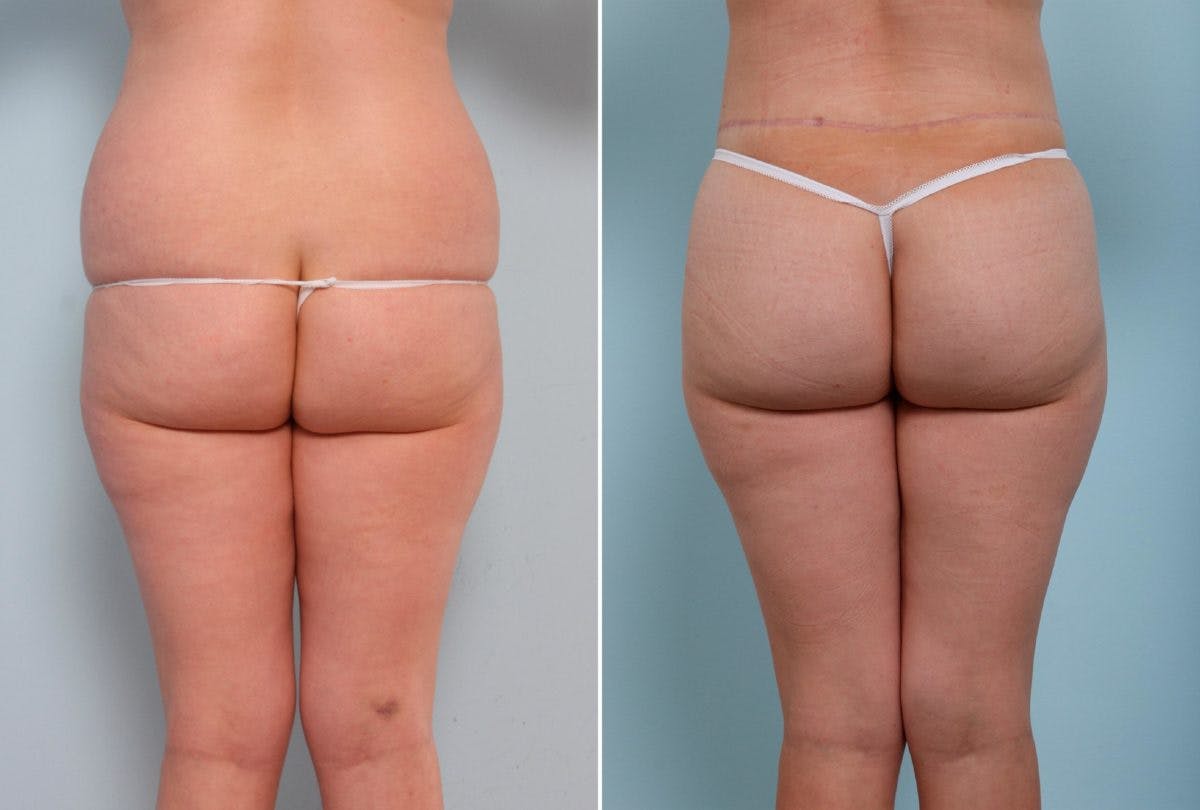 Back Lift Before & After Gallery - Patient 54881701 - Image 1