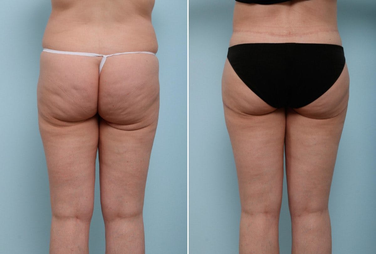 Back Lift Before & After Gallery - Patient 54881716 - Image 1