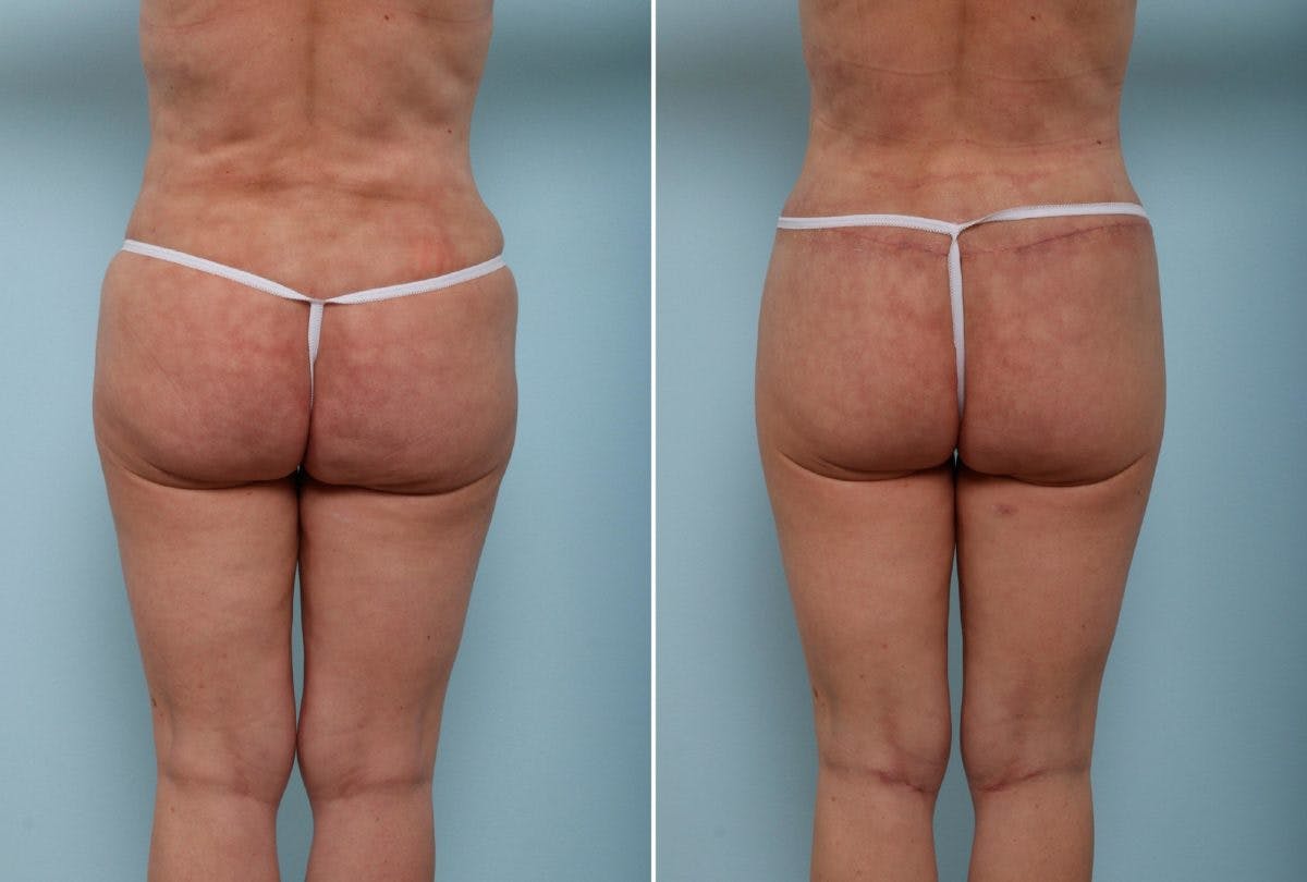 Back Lift Before & After Gallery - Patient 54881718 - Image 1