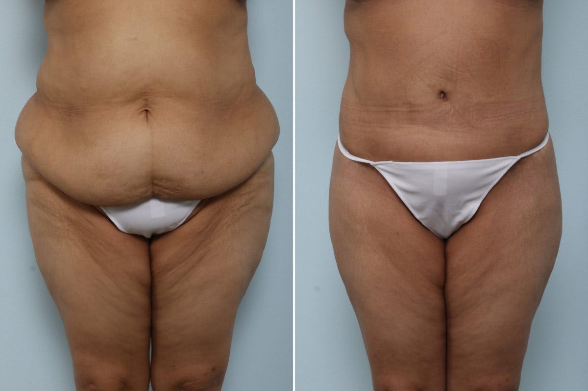 Body Lift Before & After Photo - Patient 54881805 - Image 1