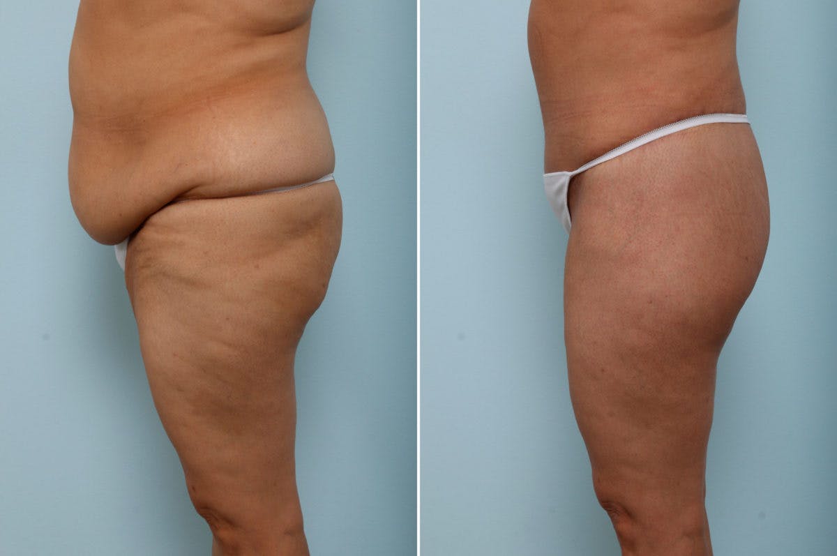 Body Lift Before & After Gallery - Patient 54881805 - Image 5