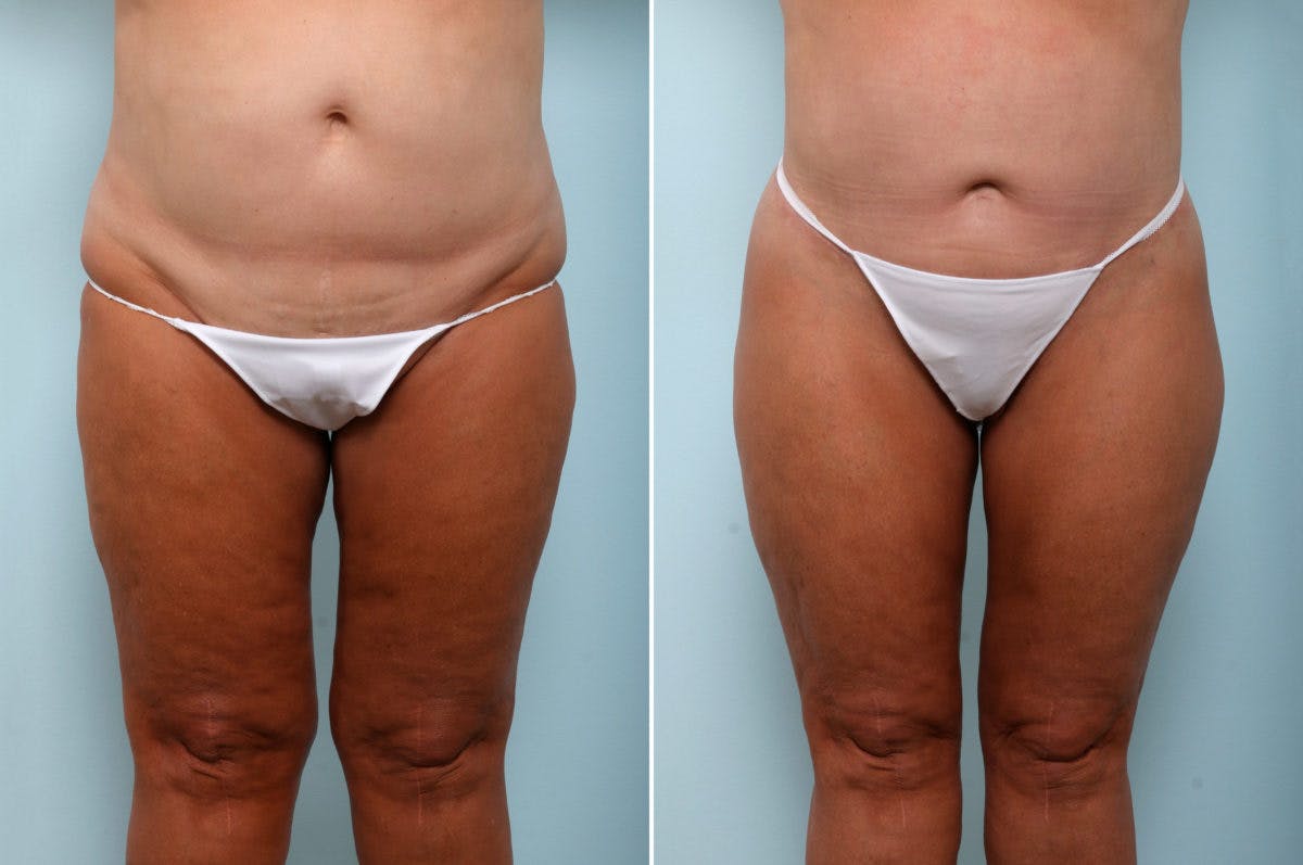 Body Lift Before & After Photo - Patient 54881809 - Image 1