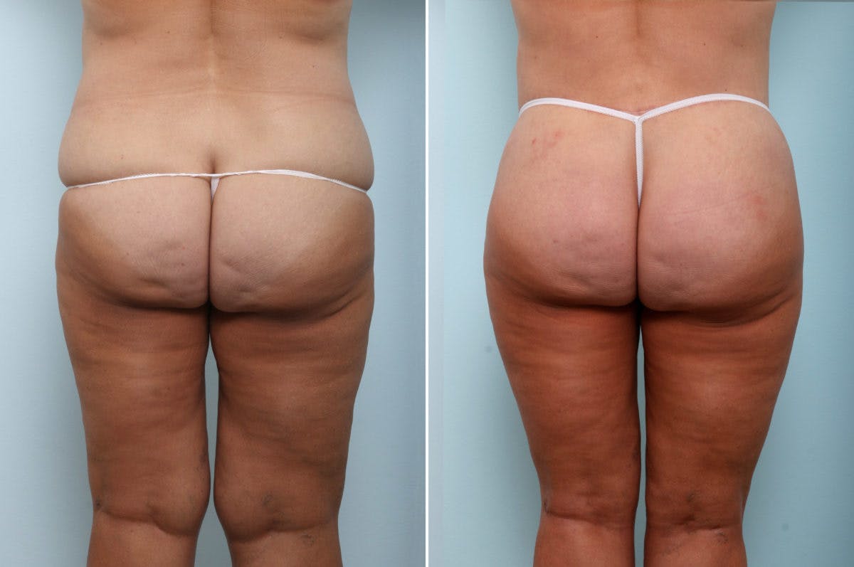 Body Lift Before & After Photo - Patient 54881809 - Image 3