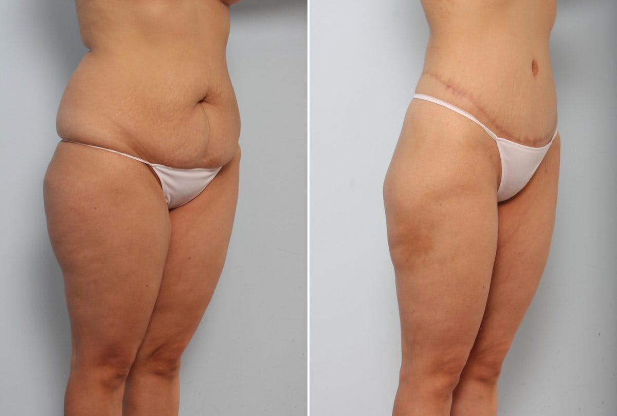 Body Lift Before & After Gallery - Patient 54881810 - Image 2