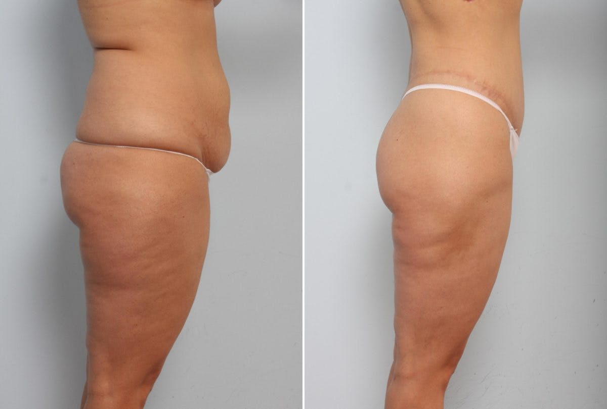 Body Lift Before & After Gallery - Patient 54881810 - Image 3