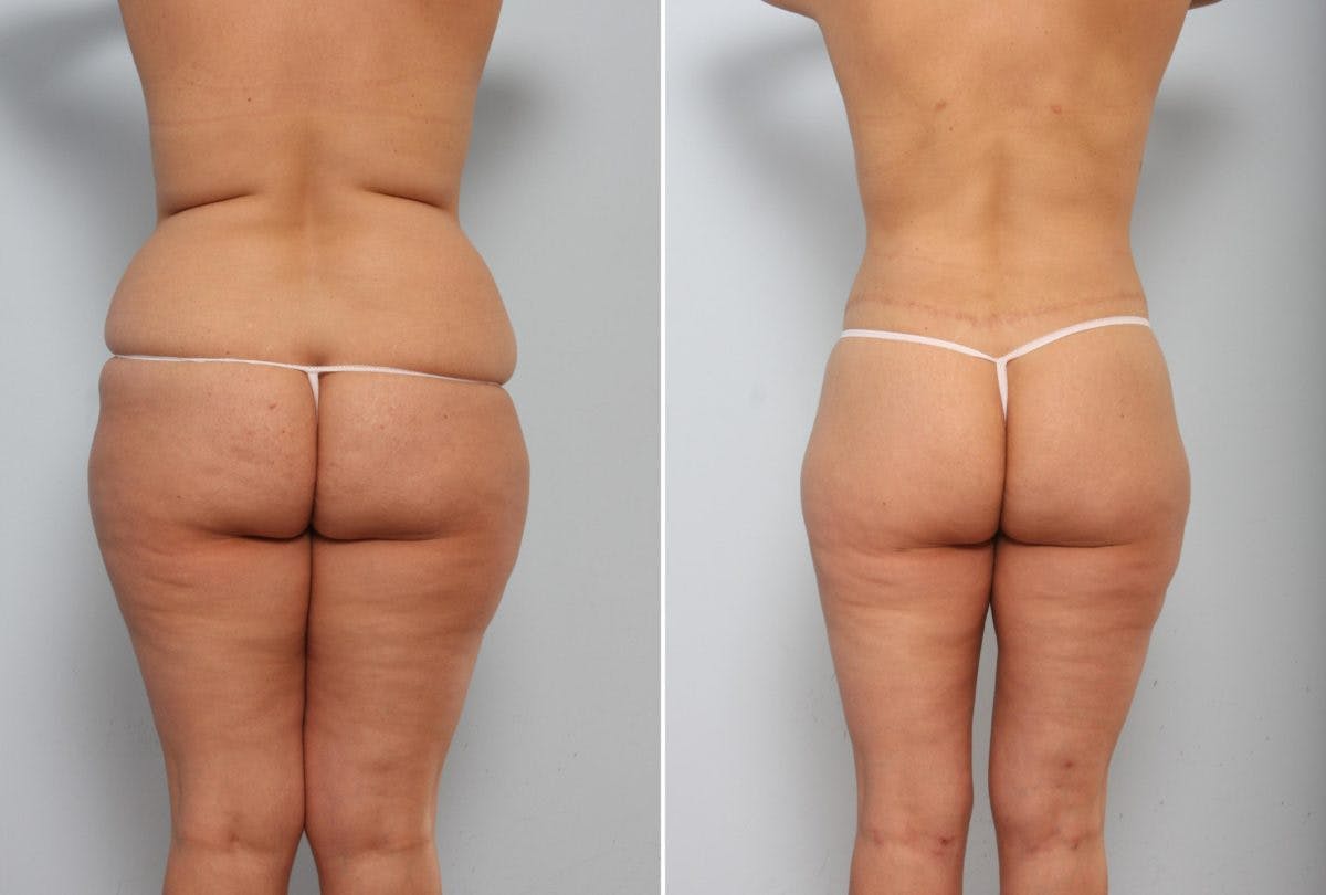 Body Lift Before & After Gallery - Patient 54881810 - Image 4