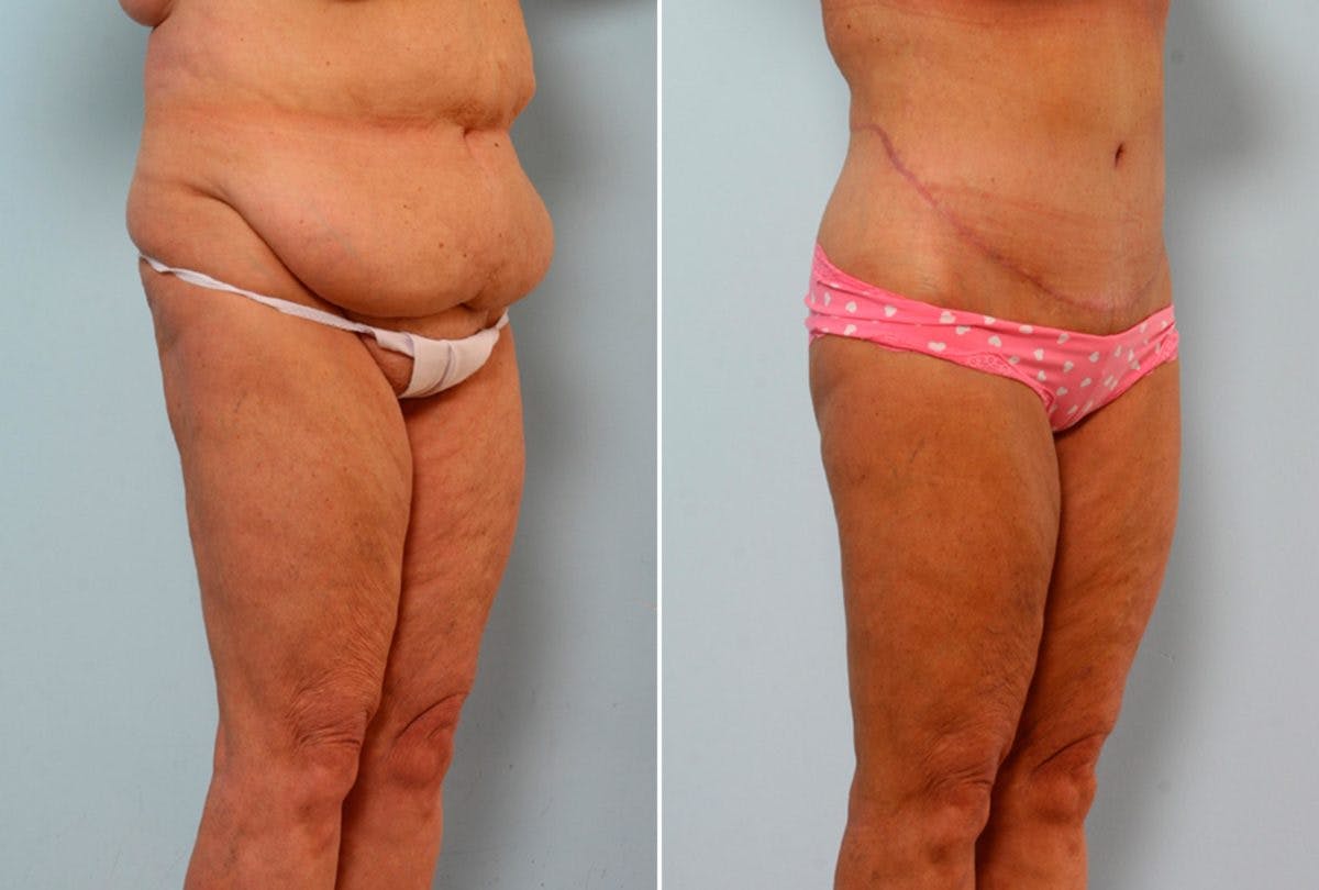 Body Lift Before & After Gallery - Patient 54881812 - Image 2