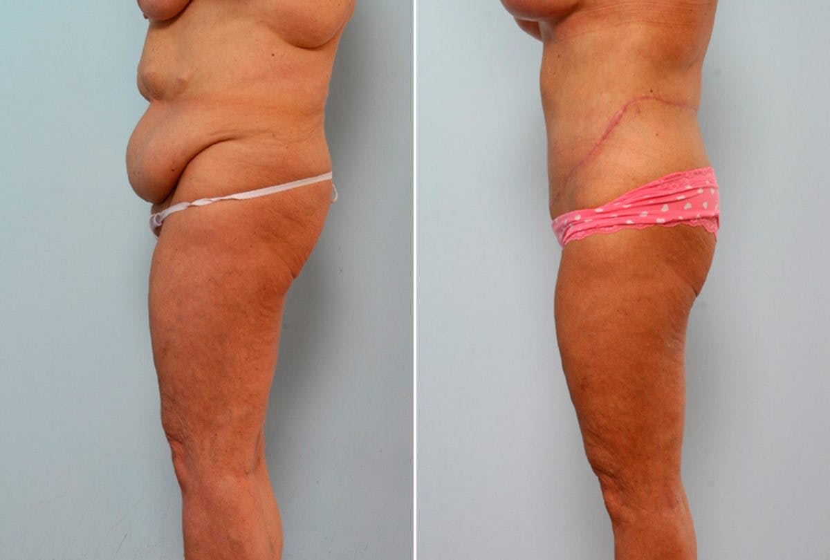 Body Lift Before & After Gallery - Patient 54881812 - Image 5